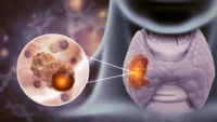 conoce-aqui-los-sintomas-de-cancer-de-tiroides-avanzado