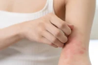 dermatitis-atpica_3
