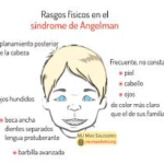Síndrome de Angelman