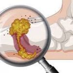 Hiperuricemia: El Enemigo Silencioso del Ácido Úrico Elevado