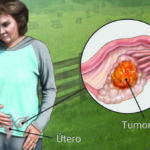 Entendiendo el cáncer de ovario: señales, riesgos y cuidados