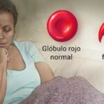 Anemia Falciforme: Una Condición Hematológica