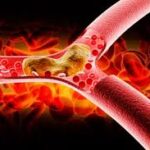 Arteriosclerosis: Endurecimiento y Engrosamiento de las Arterias