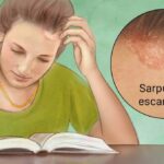 Psoriasis