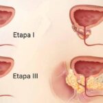 Cáncer de próstata