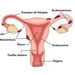 Endometriosis: Enfermedad silenciosa que afecta a millones de mujeres