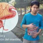 Enfermedad de Crohn: Trastorno inflamatorio intestinal crónico