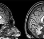 Ataxia Espinocerebelosa: Trastorno Neurodegenerativo Hereditario