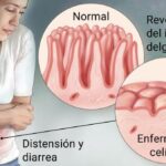 Enfermedad Celíaca