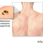 Cáncer de piel (melanoma)