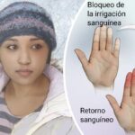 Síndrome de Raynaud
