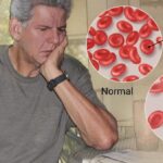 Anemia perniciosa