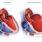 Cardiomiopatía dilatada