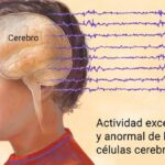 Epilepsia