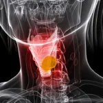 Cáncer de laringe: lo que debes saber