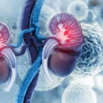 Cáncer de riñón: una enfermedad silenciosa que requiere atención temprana