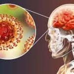 Meningitis viral: resumen informativo