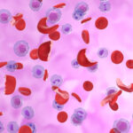 Anemia microcítica: resumen clínico