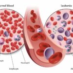 Leucemia Mieloide Crónica (LMC): resumen clínico