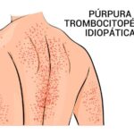 Púrpura Trombocitopénica Idiopática (PTI)