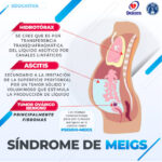 Síndrome de Meigs