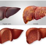 Hepatitis fulminante
