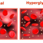 Hipoglucemia reactiva: causas, síntomas y tratamiento