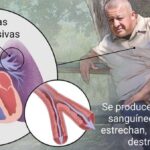 Hipertensión pulmonar: una afección grave del sistema respiratorio y cardiovascular