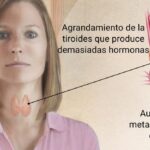 Hipertiroidismo: Cuando la Tiroides Trabaja en Exceso