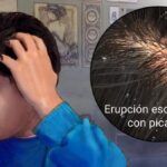 Dermatitis Seborreica: Una Condición Cutánea Común pero Molesta