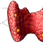Hipoparatiroidismo: Un Trastorno Hormonal Poco Frecuente pero Importante