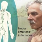 Linfoma no Hodgkin: un cáncer del sistema linfático