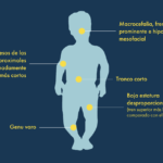 Acondroplasia