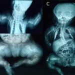 Osteogénesis imperfecta
