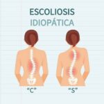 Escoliosis idiopática: definición, causas, síntomas y tratamiento