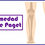 Enfermedad de Paget ósea: definición, causas, síntomas y tratamiento