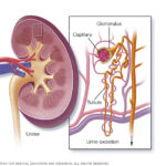 Nefritis lúpica: definición, causas, síntomas y tratamiento