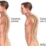 Cifosis: causas, síntomas, diagnóstico y tratamiento