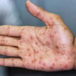 Sífilis: causas, síntomas, diagnóstico y tratamiento