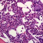 Trombocitemia esencial: causas, síntomas, diagnóstico y tratamiento