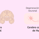 Enfermedad de Huntington