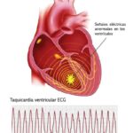 Arritmia ventricular: causas, síntomas y tratamiento