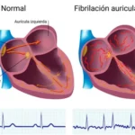 Fibrilación Auricular: cuando el ritmo del corazón se descoordina