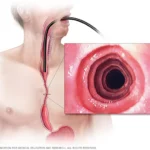 Esofagitis eosinofílica: una inflamación crónica del esófago
