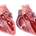 Miocardiopatía dilatada: una enfermedad que debilita el corazón