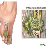 Osteomielitis: explicación completa