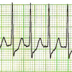 Taquicardia supraventricular (TSV)
