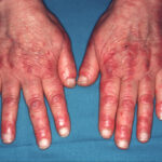 Dermatomiositis: enfermedad inflamatoria que afecta piel y músculos