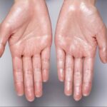 Hiperhidrosis