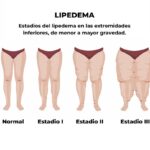 Lipedema